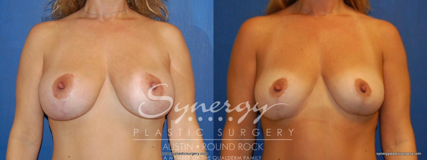Before & After Breast Reduction Case 377 View #1 View in Austin, TX