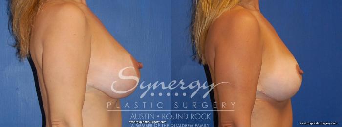 Before & After Breast Reduction Case 377 View #2 View in Austin, TX