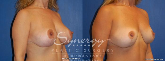Before & After Breast Reduction Case 377 View #3 View in Austin, TX