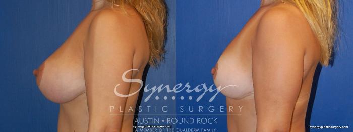 Before & After Breast Reduction Case 377 View #4 View in Austin, TX