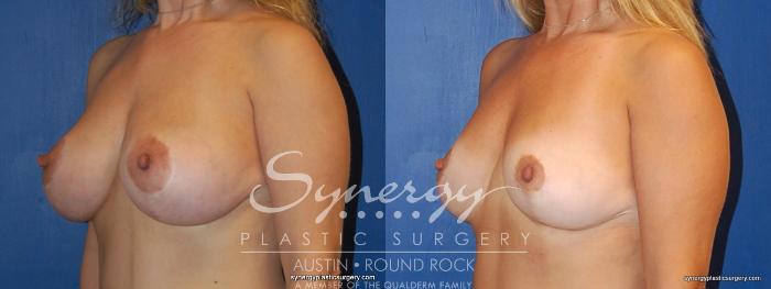 Before & After Breast Reduction Case 377 View #5 View in Austin, TX