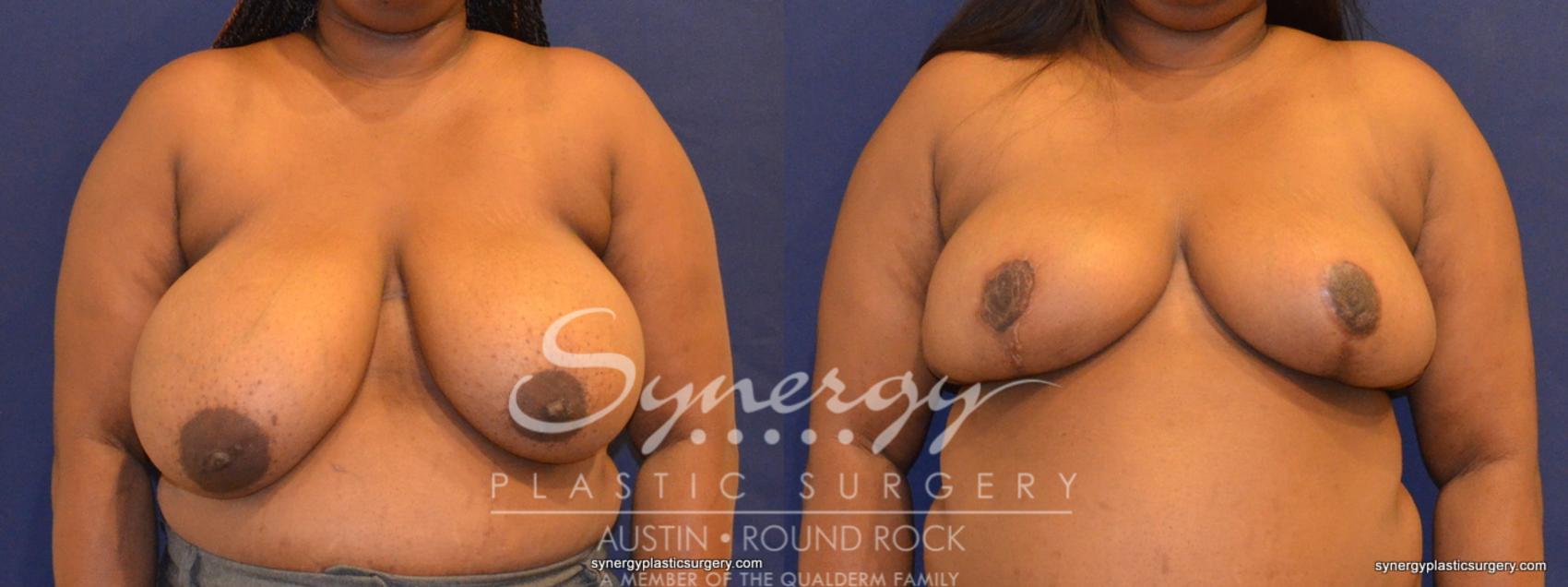 Before & After Breast Reduction Case 392 View #1 View in Austin, TX