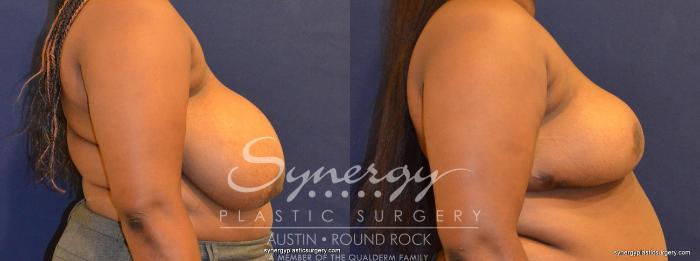 Before & After Breast Reduction Case 392 View #2 View in Austin, TX