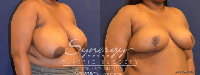 Before & After Breast Reduction Case 392 View #3 View in Austin, TX