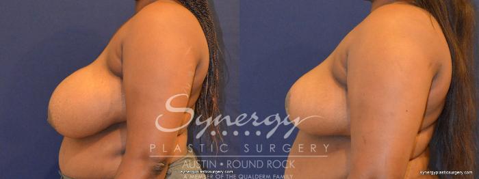Before & After Breast Reduction Case 392 View #4 View in Austin, TX