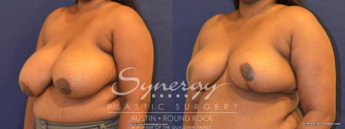Before & After Breast Reduction Case 392 View #5 View in Austin, TX