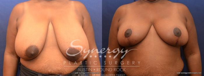 Before & After Breast Reduction Case 467 View #1 View in Austin, TX