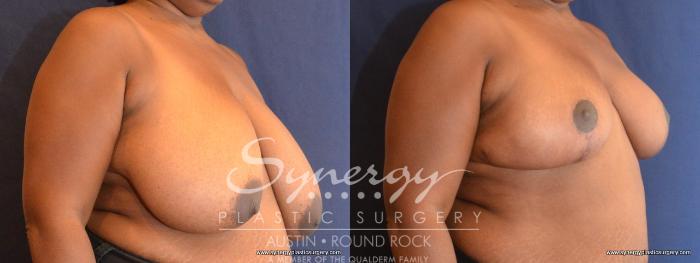 Before & After Breast Reduction Case 467 View #2 View in Austin, TX