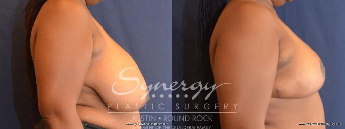Before & After Breast Reduction Case 467 View #3 View in Austin, TX