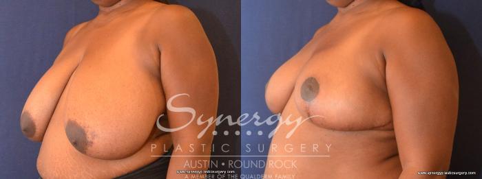 Before & After Breast Reduction Case 467 View #4 View in Austin, TX