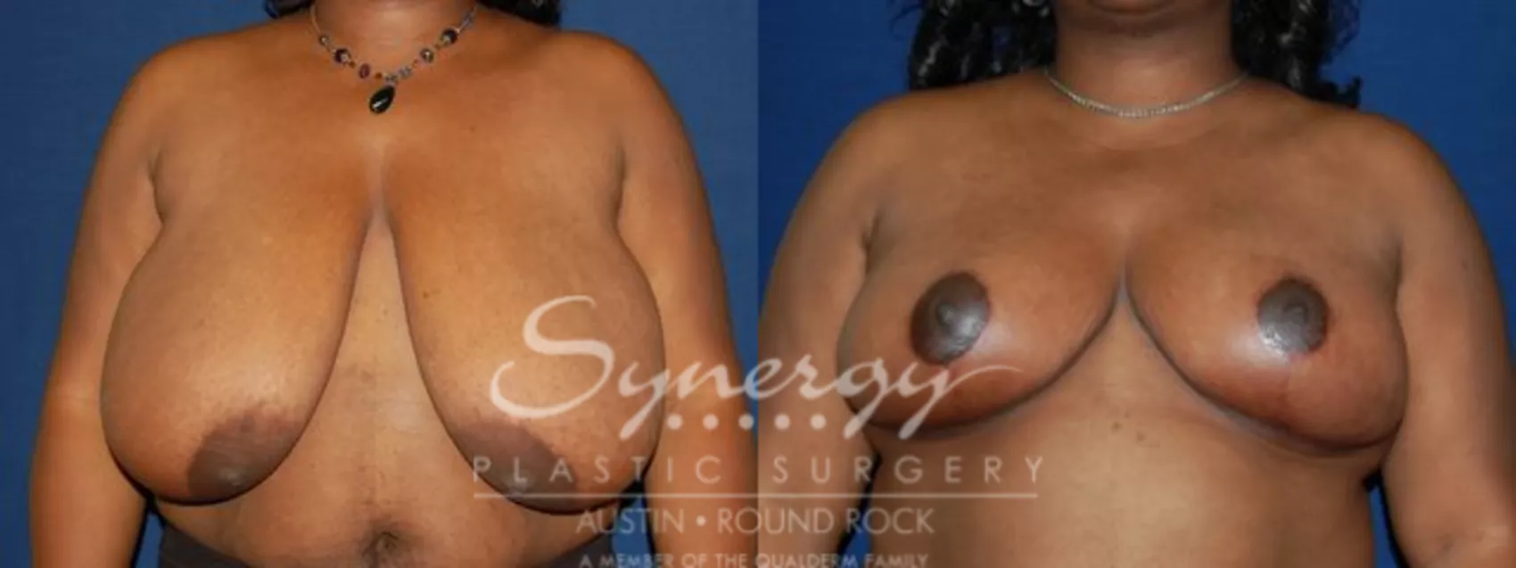 Breast Reduction Before and After Pictures Case 47 | Austin, TX | Synergy  Plastic Surgery