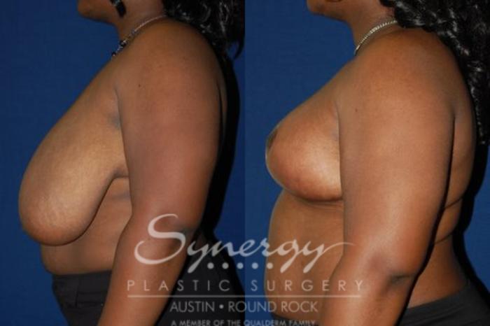 Before & After Breast Reduction Case 47 View #2 View in Austin, TX