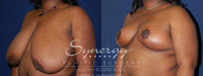 Before & After Breast Reduction Case 47 View #3 View in Austin, TX