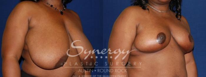 Before & After Breast Reduction Case 47 View #4 View in Austin, TX