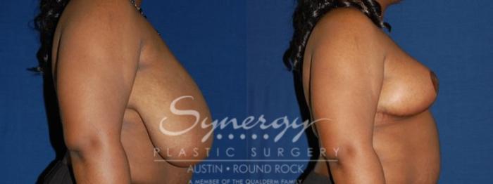 Before & After Breast Reduction Case 47 View #5 View in Austin, TX
