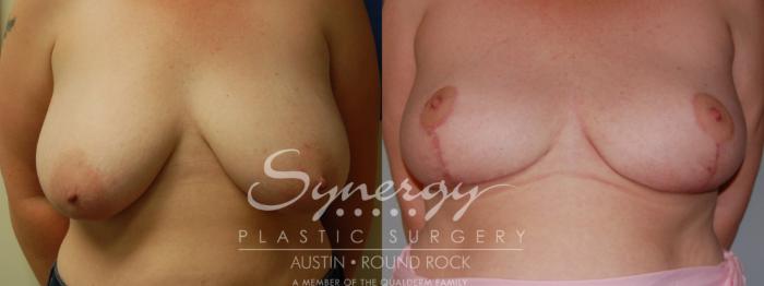Before & After Breast Reduction Case 5 View #1 View in Austin, TX