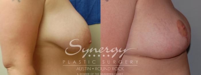 Before & After Breast Reduction Case 5 View #2 View in Austin, TX
