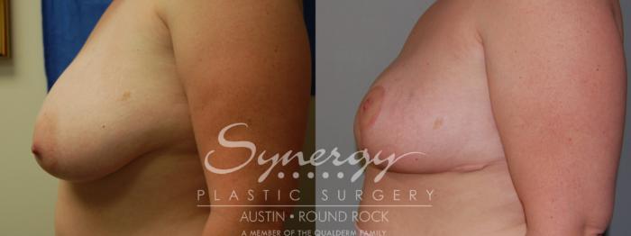 Before & After Breast Reduction Case 5 View #3 View in Austin, TX