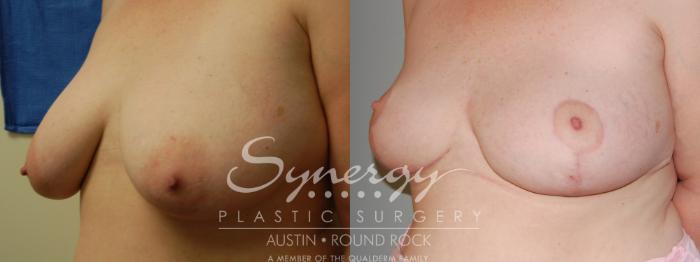 Before & After Breast Reduction Case 5 View #4 View in Austin, TX