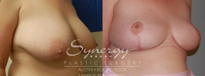 Before & After Breast Reduction Case 5 View #5 View in Austin, TX