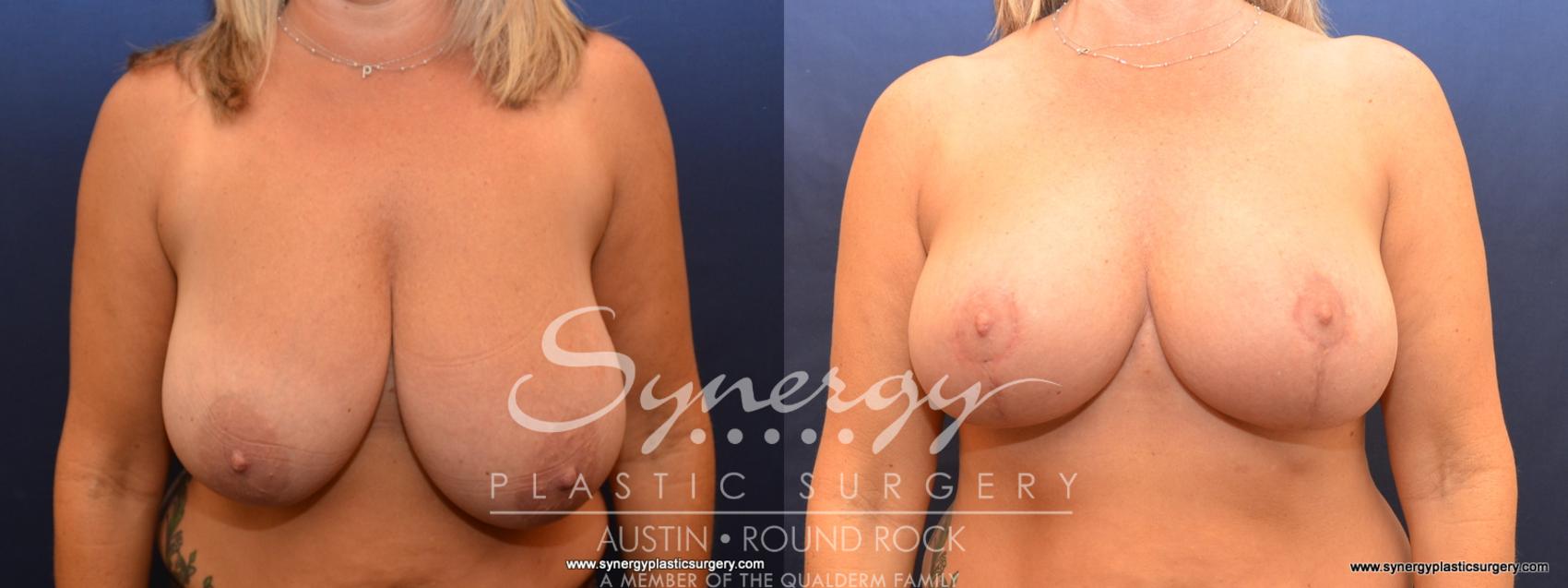 Before & After Breast Reduction Case 573 View #1 View in Austin, TX