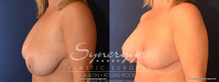 Before & After Breast Reduction Case 573 View #2 View in Austin, TX