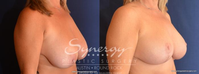 Before & After Breast Reduction Case 573 View #3 View in Austin, TX