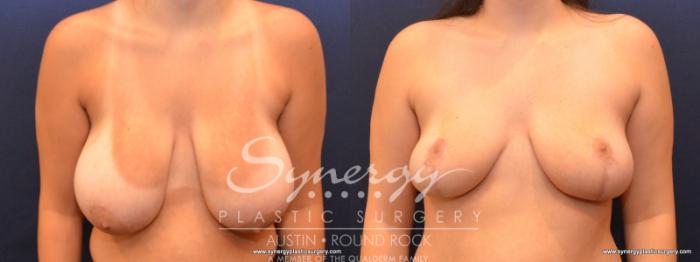 Before & After Breast Reduction Case 584 View #1 View in Austin, TX