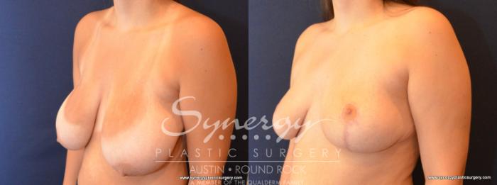 Before & After Breast Reduction Case 584 View #2 View in Austin, TX