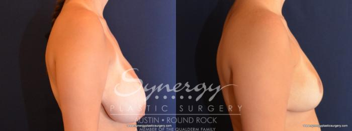 Before & After Breast Reduction Case 584 View #3 View in Austin, TX