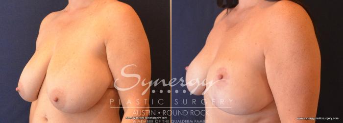 Before & After Breast Reduction Case 701 View #2 View in Austin, TX