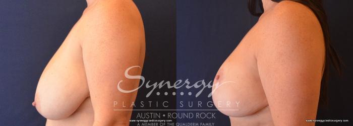 Before & After Breast Reduction Case 701 View #3 View in Austin, TX