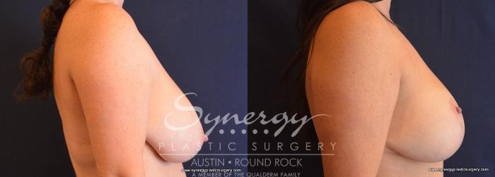 Before & After Breast Reduction Case 701 View #4 View in Austin, TX