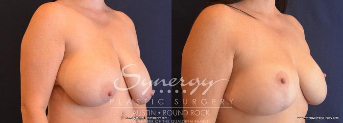 Before & After Breast Reduction Case 701 View #5 View in Austin, TX