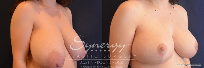 Before & After Breast Reduction Case 726 View #2 View in Austin, TX