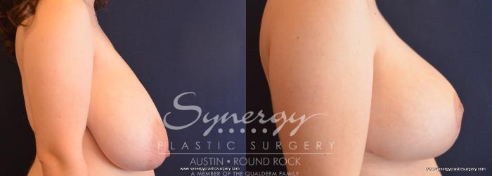 Before & After Breast Reduction Case 726 View #3 View in Austin, TX