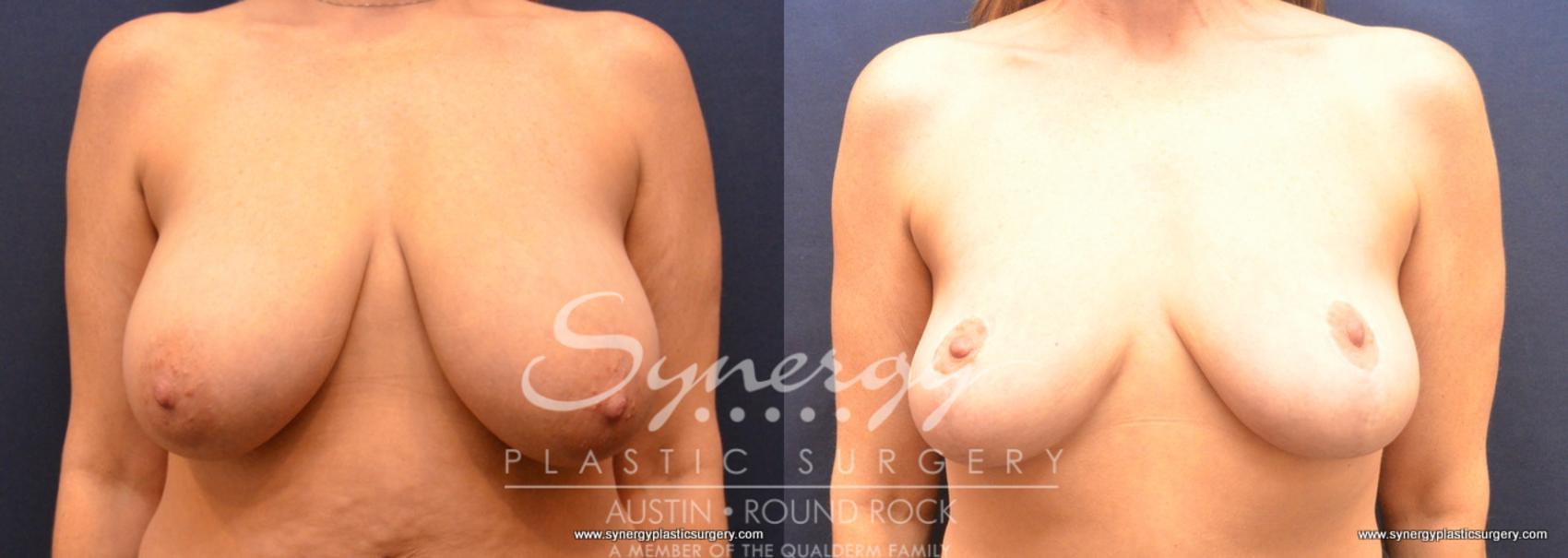 Before & After Breast Reduction Case 759 View #1 View in Austin, TX