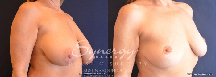 Before & After Breast Reduction Case 759 View #2 View in Austin, TX