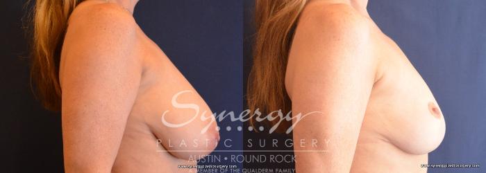 Before & After Breast Reduction Case 759 View #3 View in Austin, TX
