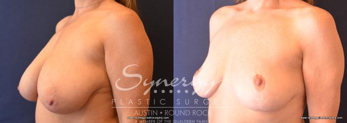 Before & After Breast Reduction Case 759 View #4 View in Austin, TX
