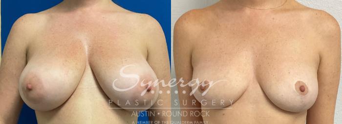Before & After Breast Reduction Case 877 Front View in Austin, TX
