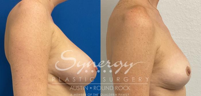 Before & After Breast Reduction Case 877 Left Side View in Austin, TX