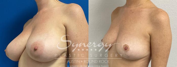 Before & After Breast Reduction Case 877 Right Side View in Austin, TX