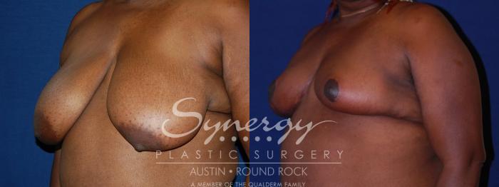 Before & After Breast Reduction Case 88 View #2 View in Austin, TX