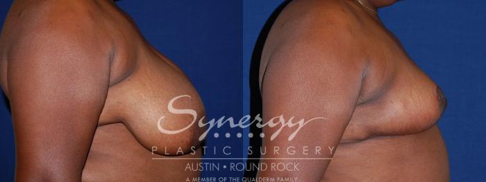 Before & After Breast Reduction Case 88 View #3 View in Austin, TX