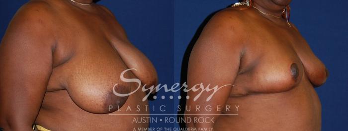 Before & After Breast Reduction Case 88 View #4 View in Austin, TX