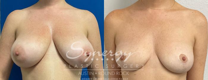 Before & After Breast Lift (Mastopexy) Case 888 Front View in Austin, TX