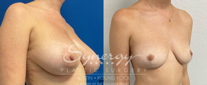 Before & After Breast Lift (Mastopexy) Case 888 Left Oblique View in Austin, TX