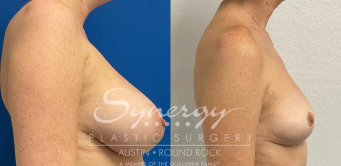Before & After Breast Lift (Mastopexy) Case 888 Left Side View in Austin, TX