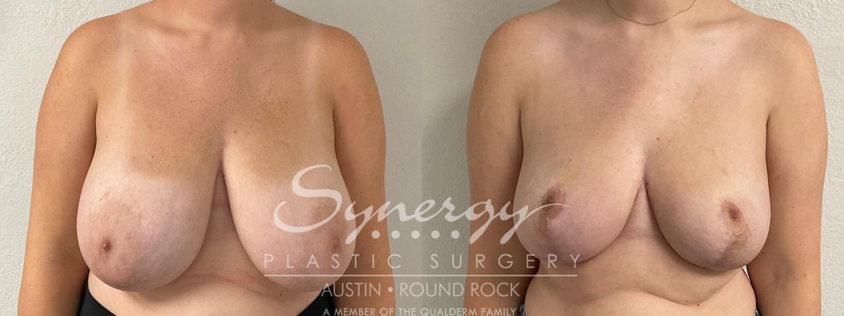 Before & After Breast Reduction Case 893 Front View in Austin, TX